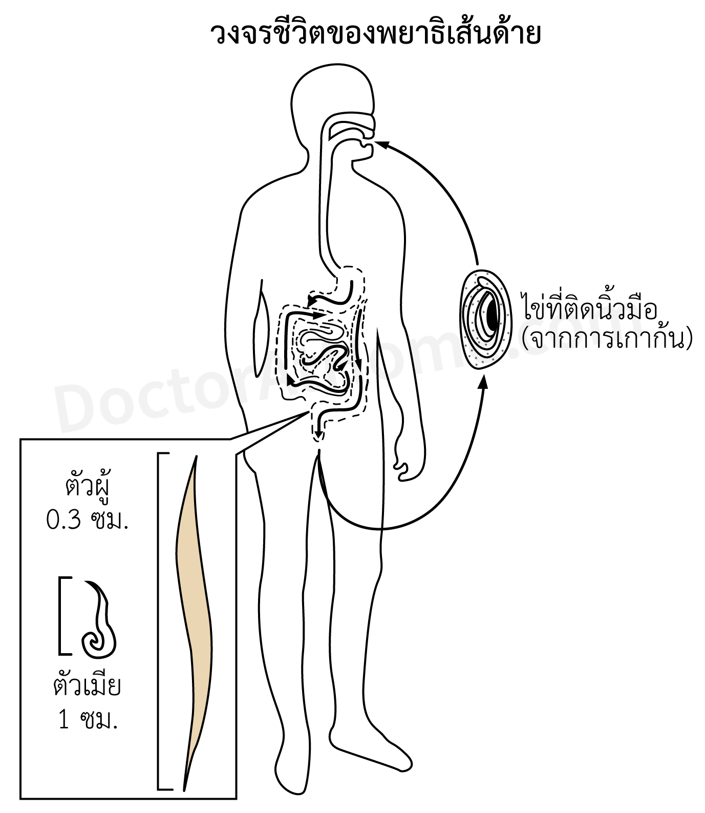 โรคพยาธิเส้นด้าย